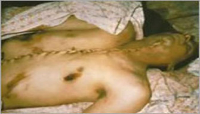 برنامج أمريكي يصنِّف الكيان الصهيوني كمركز لسرقة الأعضاء