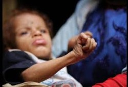 11 مليون طفل يعانون من سوء التغذية الحاد