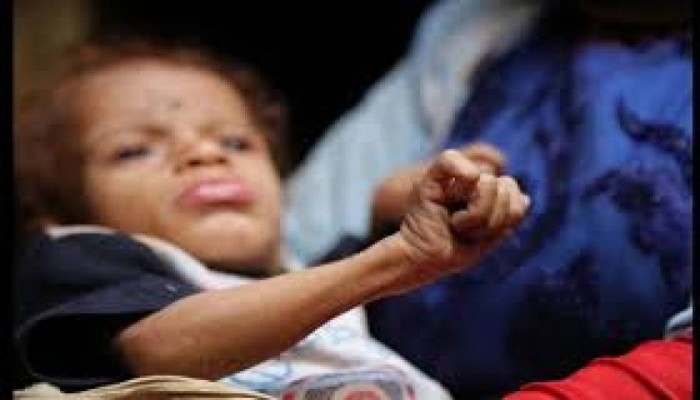 11 مليون طفل يعانون من سوء التغذية الحاد
