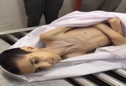 استشهاد 3 أطفال بمشفى الشفاء نتيجة سوء التغذية والجفاف