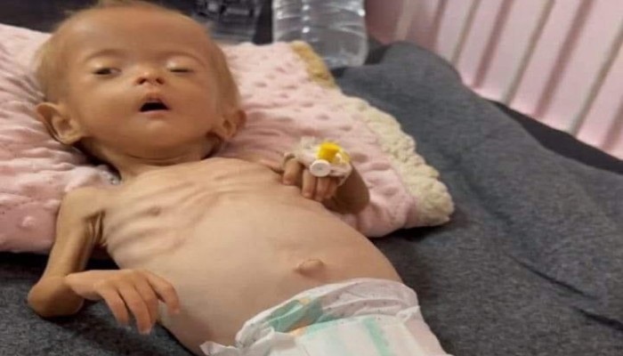 استشهاد طفلة في خان يونس نتيجة سوء التغذية