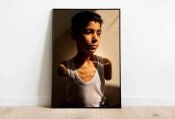 صورة طفل فلسطيني مبتور الذراعين تفوز بجائزة وورلد برس فوتو