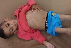 أطفال غزة في أشد مراحل سوء التغذية