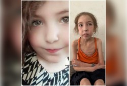 الطفلة رهف عياد.. جسد يتآكل بفعل الحصار والتجويع في غزة