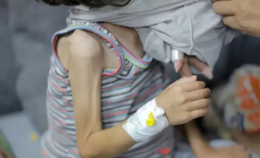 66 ألف طفل في قطاع غزة يعانون سوء تغذية خطيرا