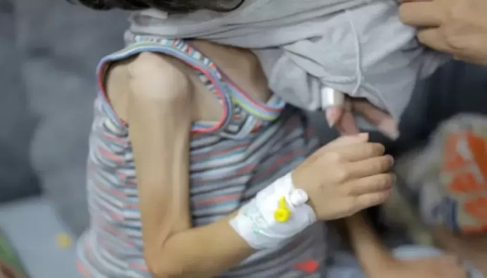 66 ألف طفل في قطاع غزة يعانون سوء تغذية خطيرا