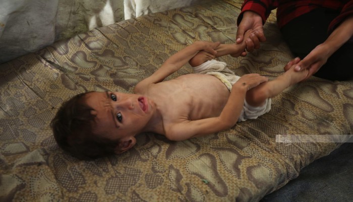 122 شهيدًا منهم 83 طفلا بجريمة الاحتلال في تجويع غزة