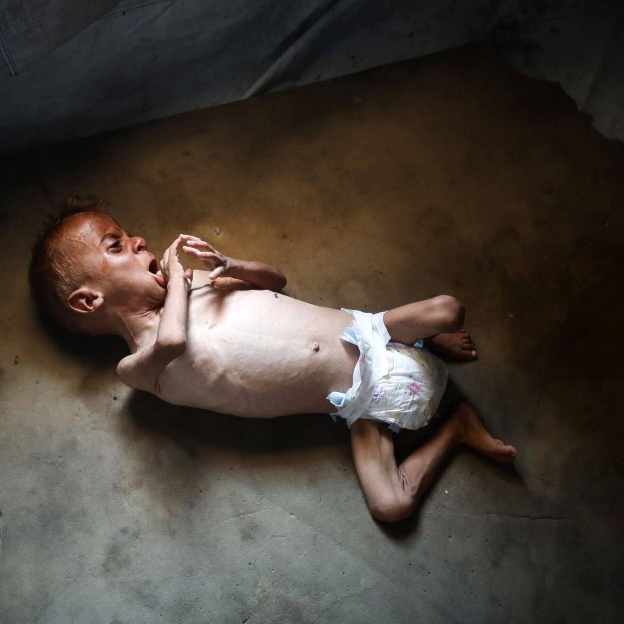 100 ألف طفل في غزة يتعرضون لخطر الموت خلال أيام