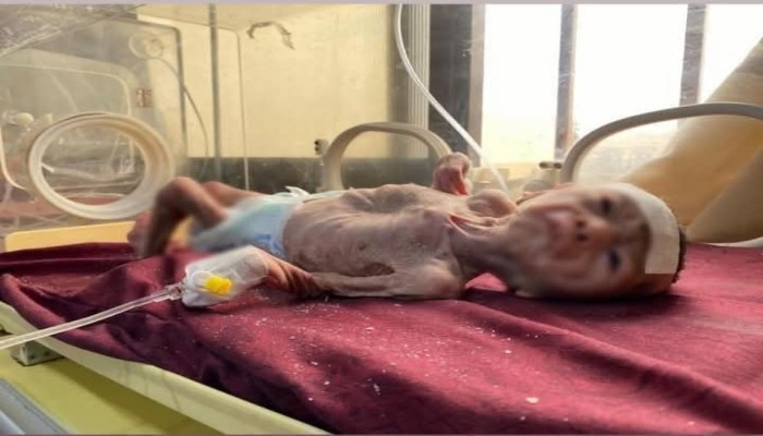 14 شهيدًا بالتجويع في غزة والحصيلة ترتفع إلى 147 منهم 88 طفلا