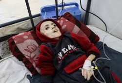 استشهاد حالتي جوع شديد اليوم في غزة