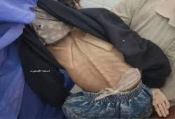 استشهاد حالتين جوعا في غزة خلال 24 ساعة