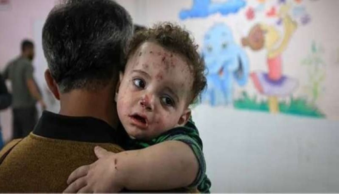 الجدري ينهش أجساد الأطفال في غزة.. الأزمة الصحية تتفاقم